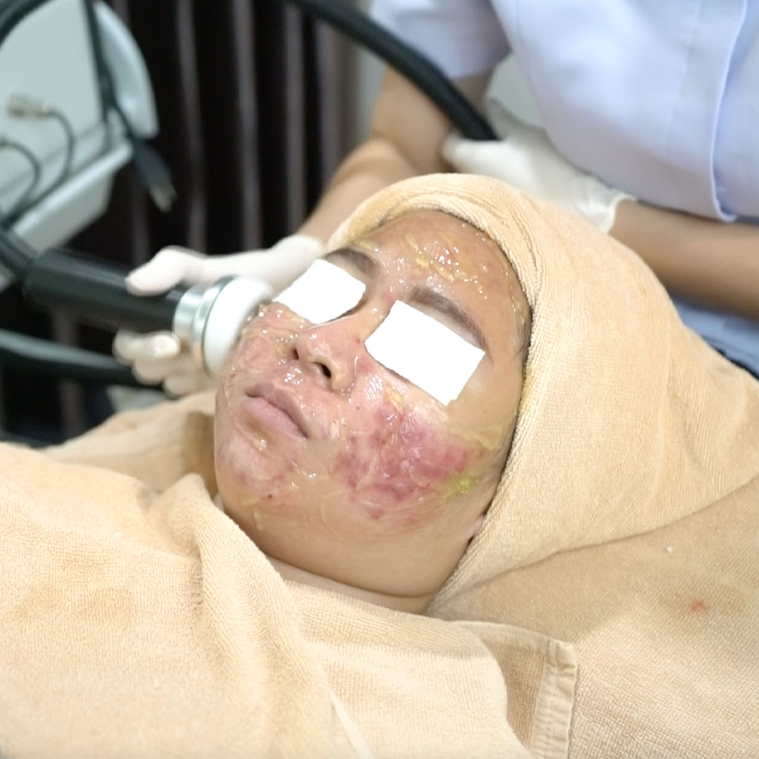 คำแนะนำระหว่างการรักษาสิว